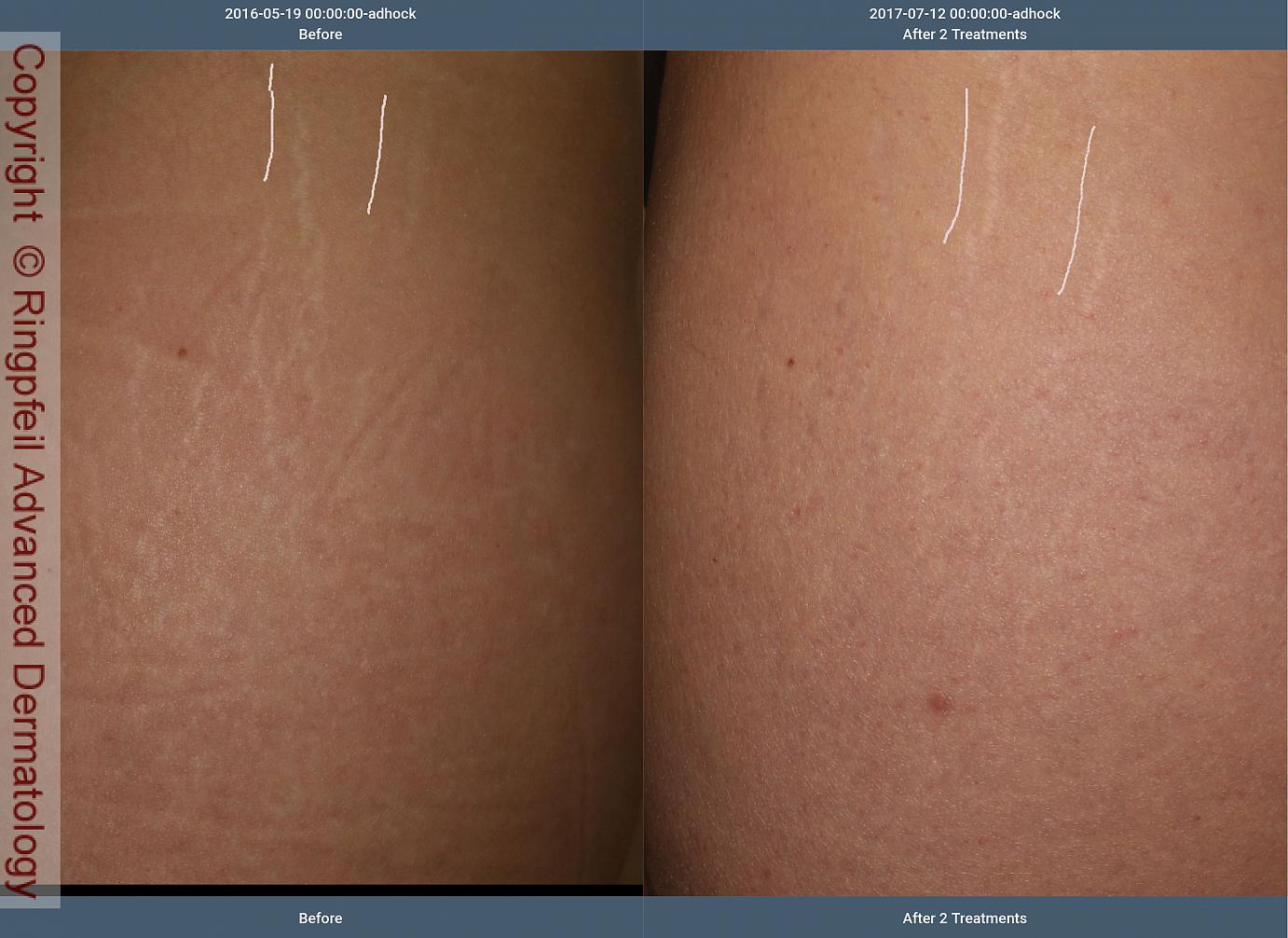 vorläufer sich verhalten person stretch marks before and after laser